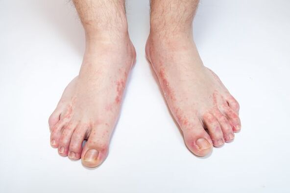 kožne glivice na nogah