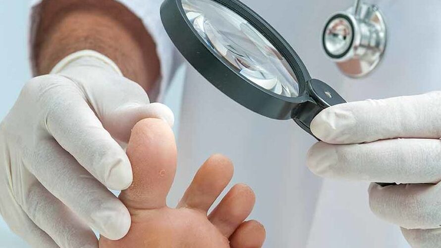 Diagnozo glivic na nohtih na nogah opravi dermatolog