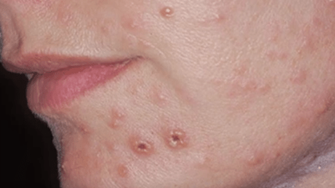 Glivična okužba kože na obrazu