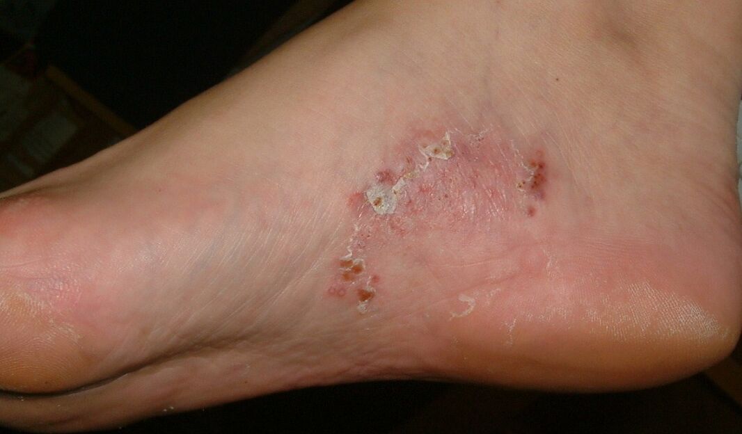 Manifestacije glivične okužbe na stopalu